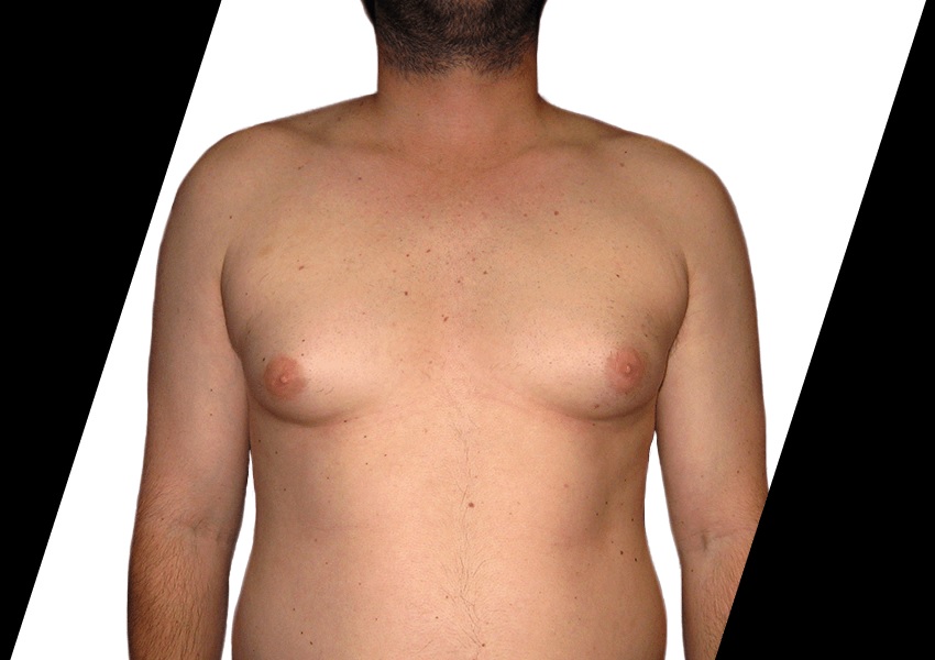 What Are the Benefits of Choosing Laser Liposuction?