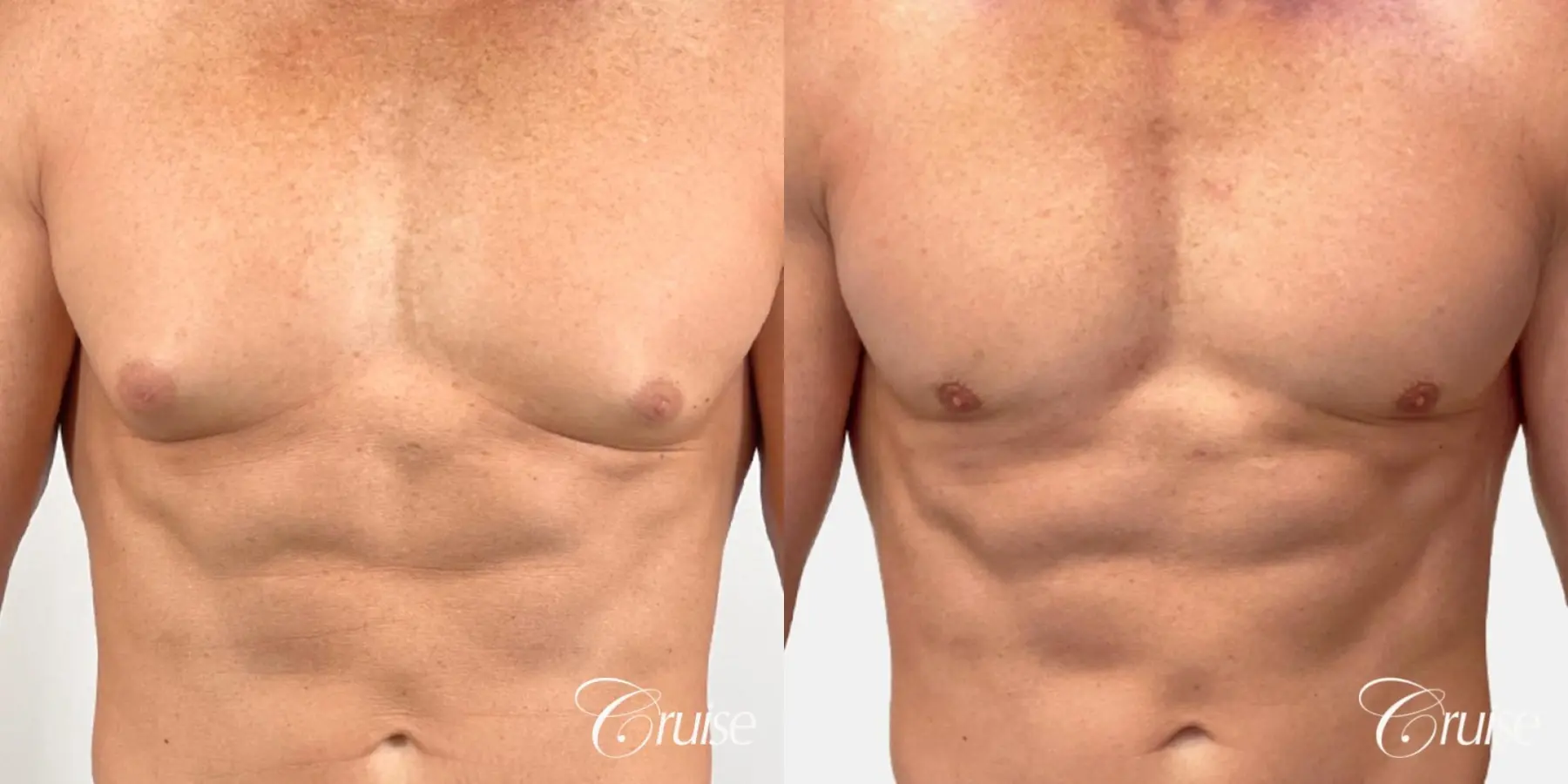 Real Results: Before and After Man Boobs Surgery Islamabad