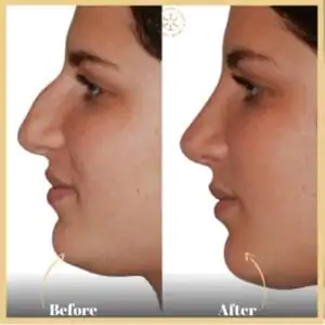 The Benefits of Nose Structure Correction Islamabad for Functional and Aesthetic Improvement
