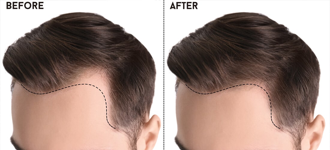 Rediscovering Confidence: A Comprehensive Guide to Hair Transplants in Pakistan