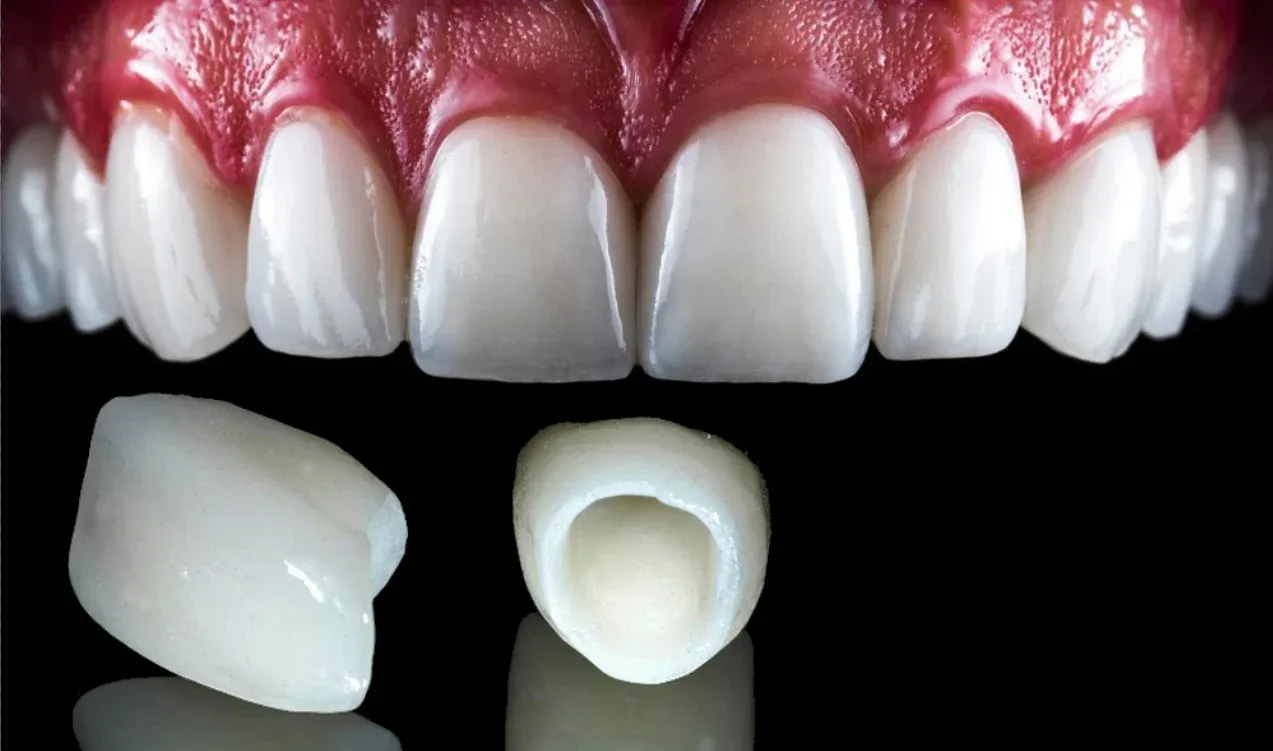 full mouth implants near me
