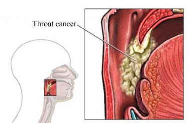 Throat Cancer Treatment in India: Cost, Procedures & Best Hospitals Explained