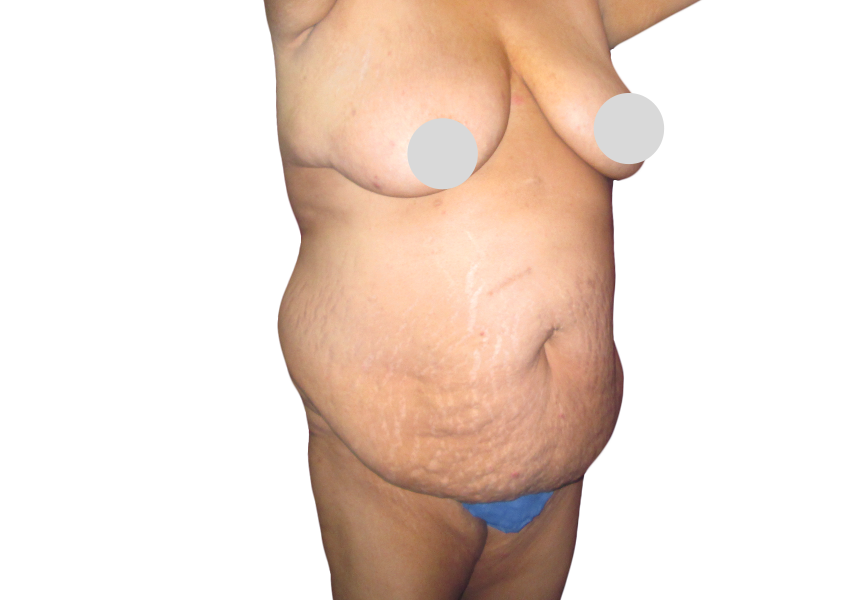 Belly Fat Removal Surgery