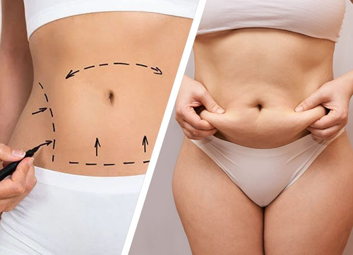 Liposuction treatment in Islamabad