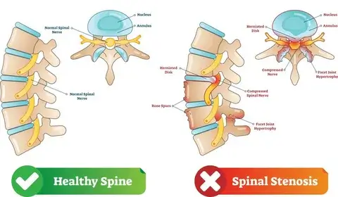 Understanding S1 Spinal Health Challenges