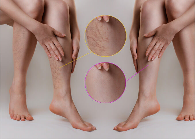 Do I need a vascular specialist for varicose veins?