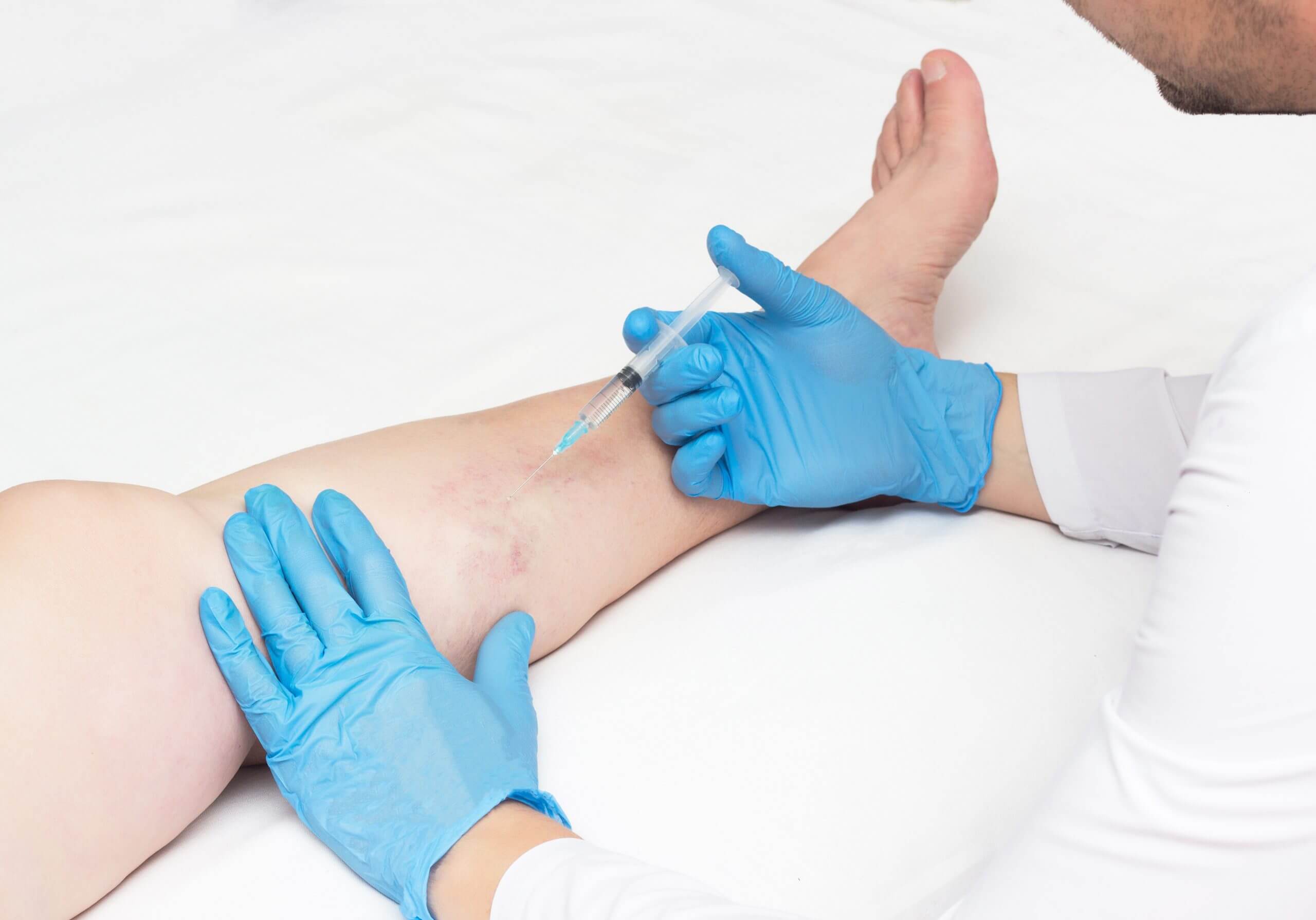 Do spider veins return after laser treatment?