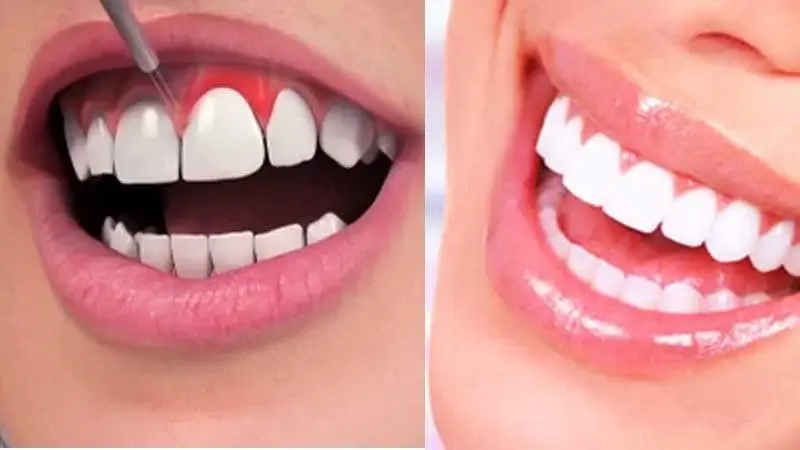 What Results Can I Expect from Six Month Smiles?